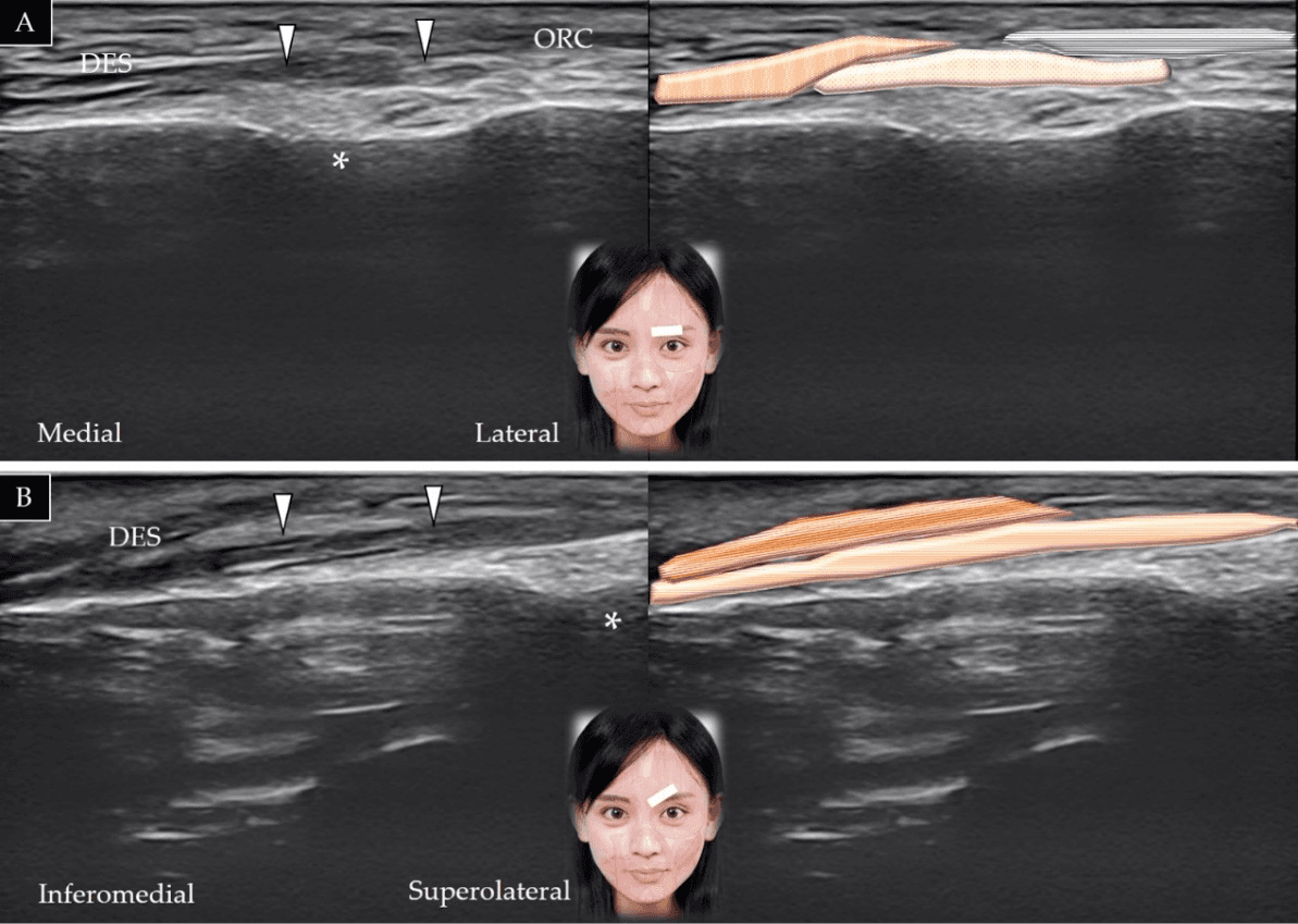보툴리눔독소 - 추미근(corrugator supercilii)의 단축(A)과 장축(B)에 대한 초음파 스캔 및 도식적 표현입니다. *는 안와상공(supraor