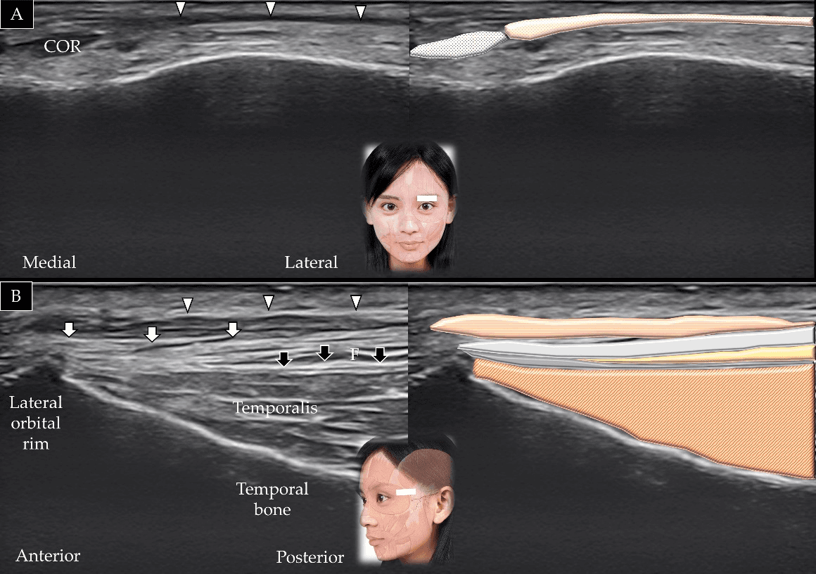 보툴리눔독소 - 눈썹 위쪽(A)과 외측 안와연 외측부(B)에서 눈둘레근(orbicularis oculi)에 대한 초음파 스캔 및 도식적 표현입니다. 흰색 화살표