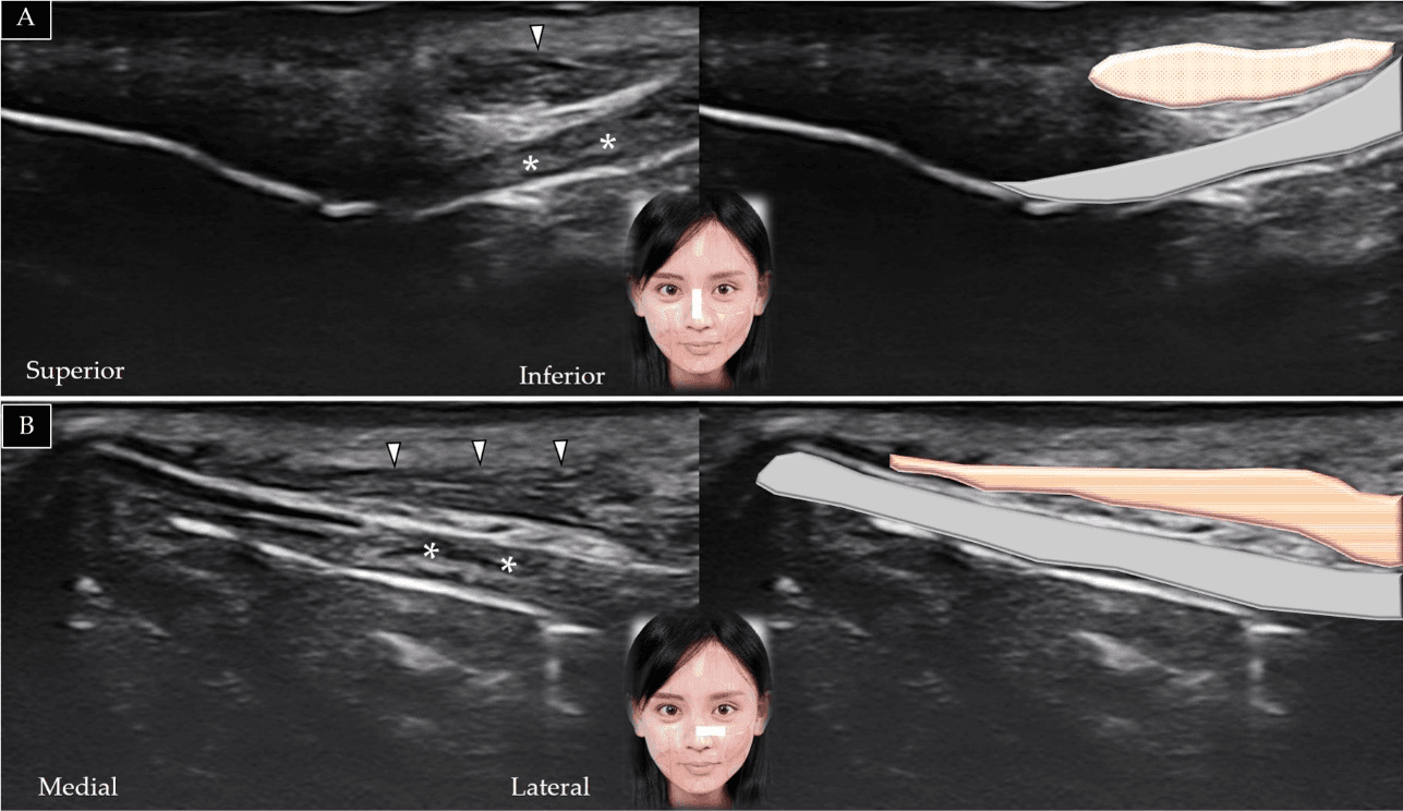 보툴리눔독소 - 비근(nasalis)의 단축(A)과 장축(B)에 대한 초음파 스캔 및 도식적 표현입니다. *와 회색 음영은 비연골(nasal cartilage)