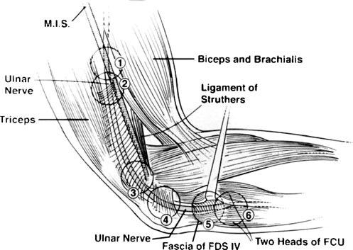 내측상과 - 주관 터널을 따른 제안된 포획 지점입니다. 주관 터널(cubital tunnel) 영역에서 척골 신경 포획의 6개 제안 부위: (1) 척골 신경