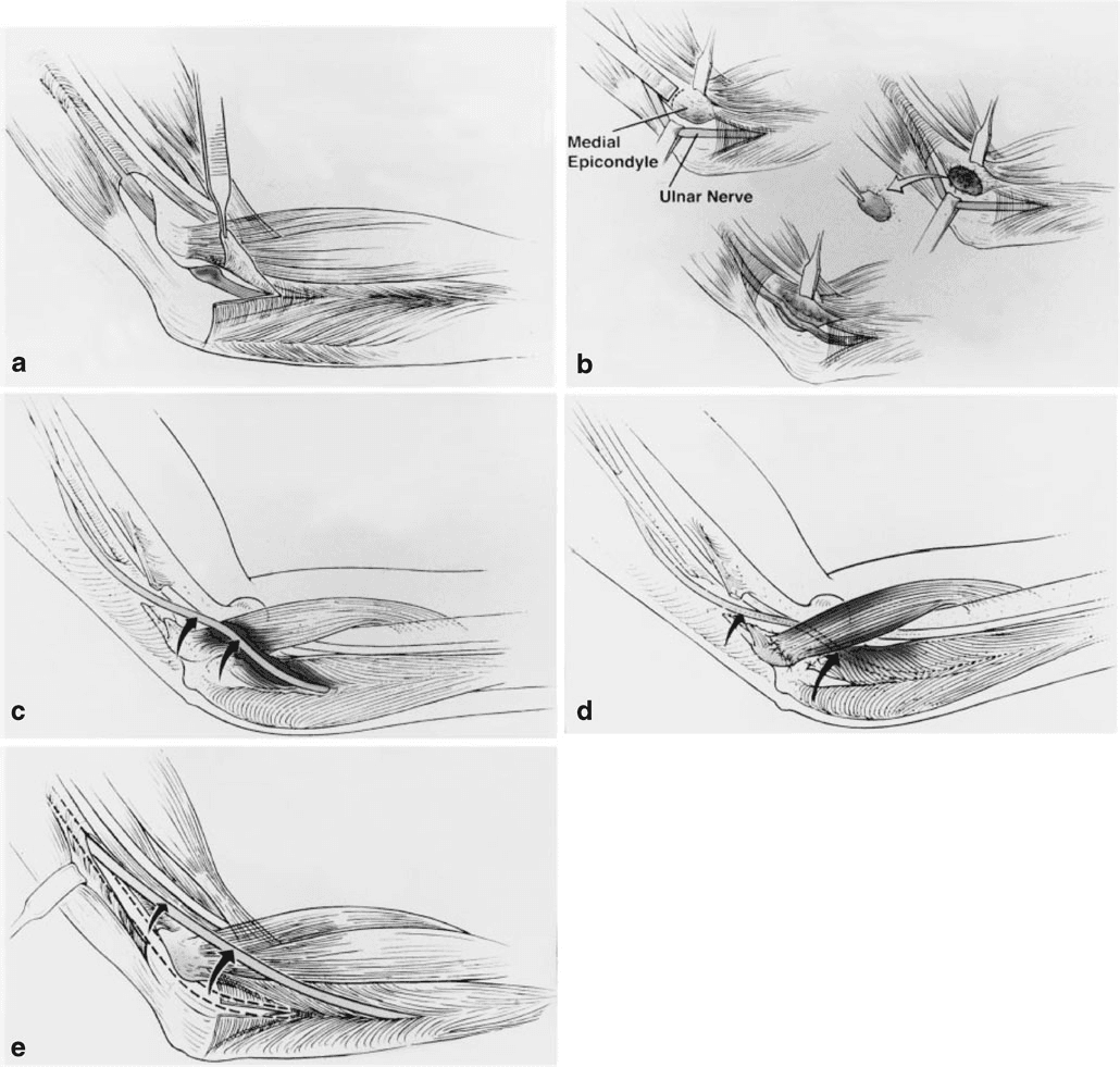 내측상과 - 주관 터널 증후군에 대한 수술적 처치법입니다. 주관 터널 증후군에 사용되는 일반적으로 시행되는 각 수술적 처치법의 종합 임상 성공률은 유사합니다