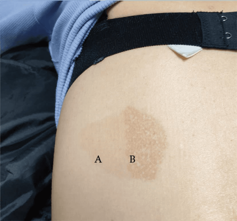 레이저치료 - 분할 병변 연구입니다. (A) GPT는 좌측 병변에서 PIH와 반점형 색소감소증을 유발하지 않음; (B) 532nm 피코초 레이저 치료는 우측 