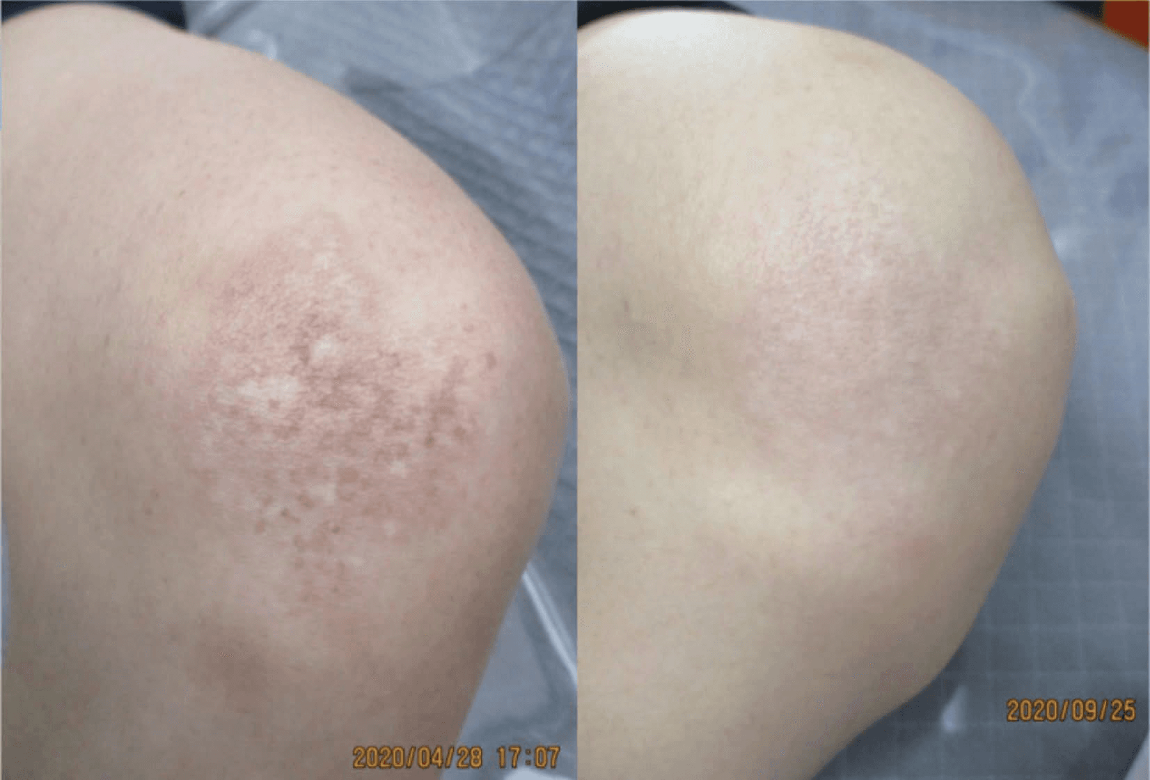 레이저치료 - (a) 전통적인 532nm 피코초 레이저 치료로 인한 좌측 무릎의 이색소침착증을 동반한 복합성 PUL (치료 전: 2020/4/28); (b) 