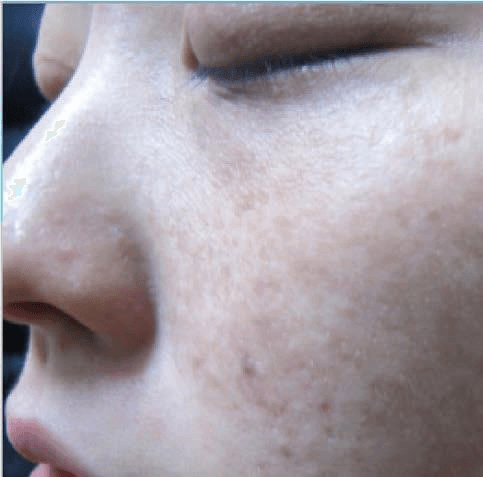 레이저치료 - (a) 좌측 안와하부위, 좌측 볼뼈부위, 좌측 뺨의 PUL(융합형 갈색 반점 유형) (치료 전: 2016/9/20); (b) 골드플라즈마 치료(