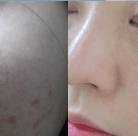 레이저치료 - (a) 좌측 안와하부위, 좌측 볼뼈부위, 좌측 뺨의 PUL(융합형 갈색 반점 유형) (치료 전: 2016/9/20); (b) 골드플라즈마 치료(