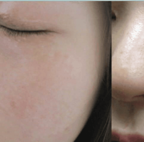 레이저치료 - (a) 좌측 안와하부위, 좌측 볼뼈부위, 좌측 뺨의 PUL(융합형 갈색 반점 유형) (치료 전: 2016/9/20); (b) 골드플라즈마 치료(