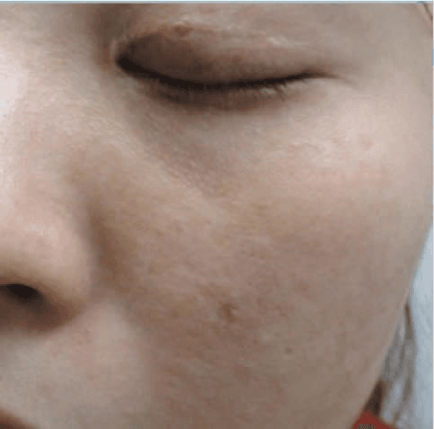 레이저치료 - (a) 좌측 안와하부위, 좌측 볼뼈부위, 좌측 뺨의 PUL(융합형 갈색 반점 유형) (치료 전: 2016/9/20); (b) 골드플라즈마 치료(