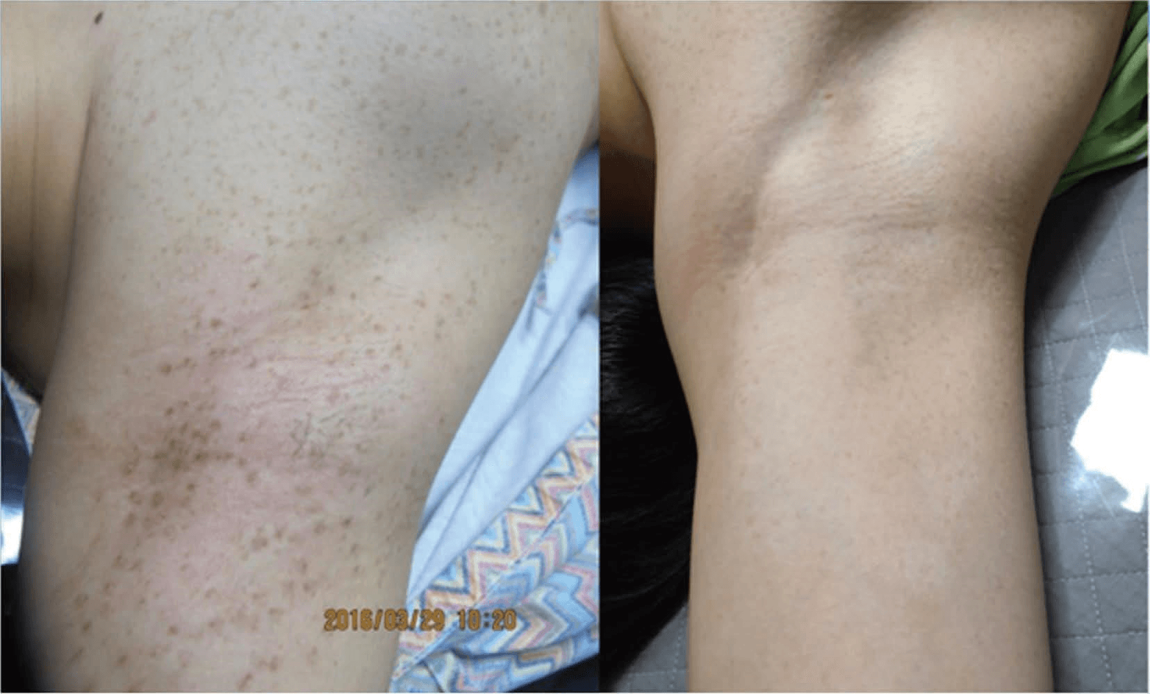 레이저치료 - (a) 우측 겨드랑이와 우측 가슴의 PUL(집합형 독립 흑자 유형) (치료 전: 2016/3/29); (b) GPT 치료 후 PUL의 완전한 소