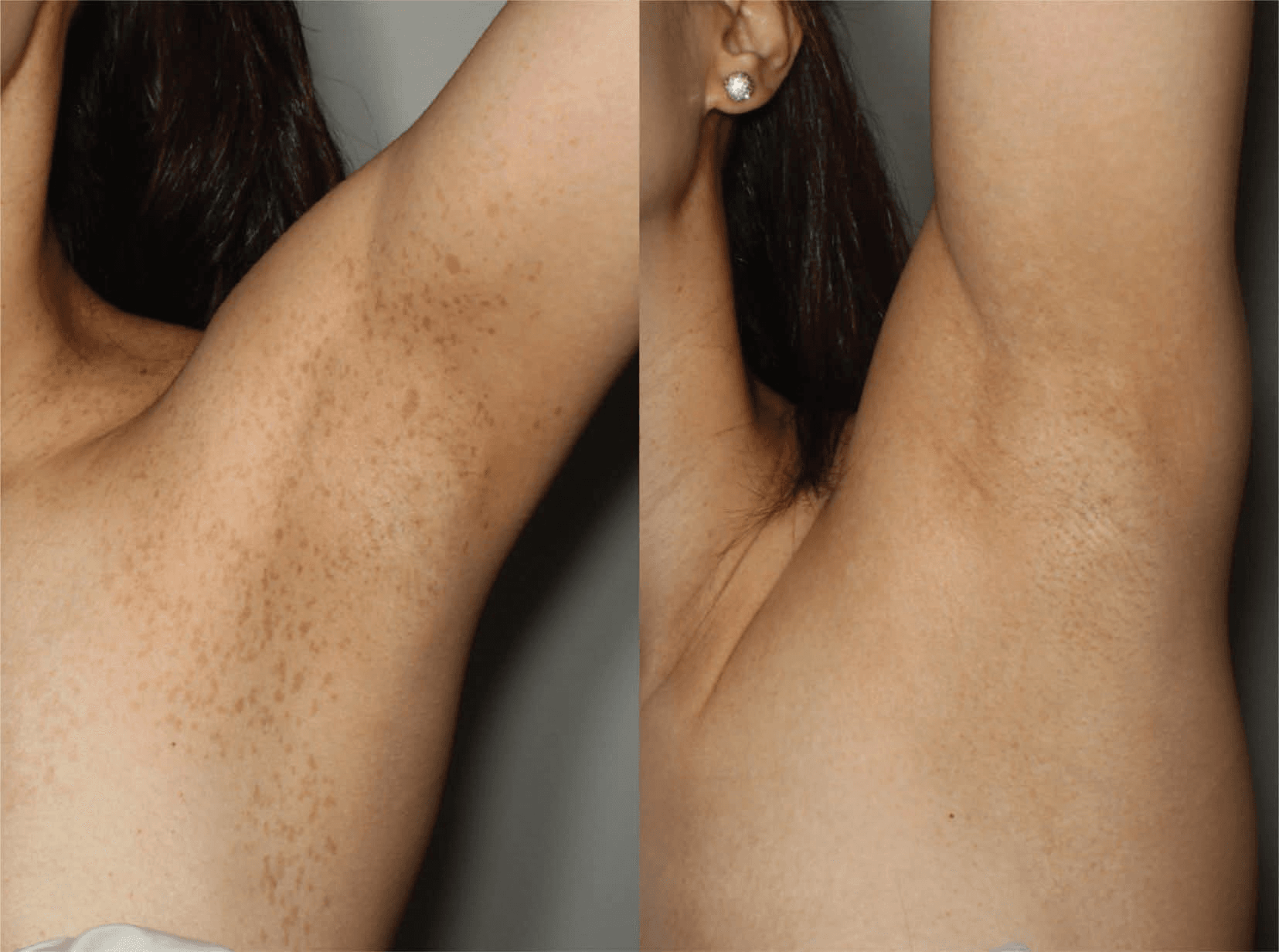 레이저치료 - (a) 좌측 겨드랑이와 좌측 가슴의 PUL(집합형 독립 흑자 유형) (치료 전: 2021/2/27); (b) GPT 치료 후 PUL의 완전한 소