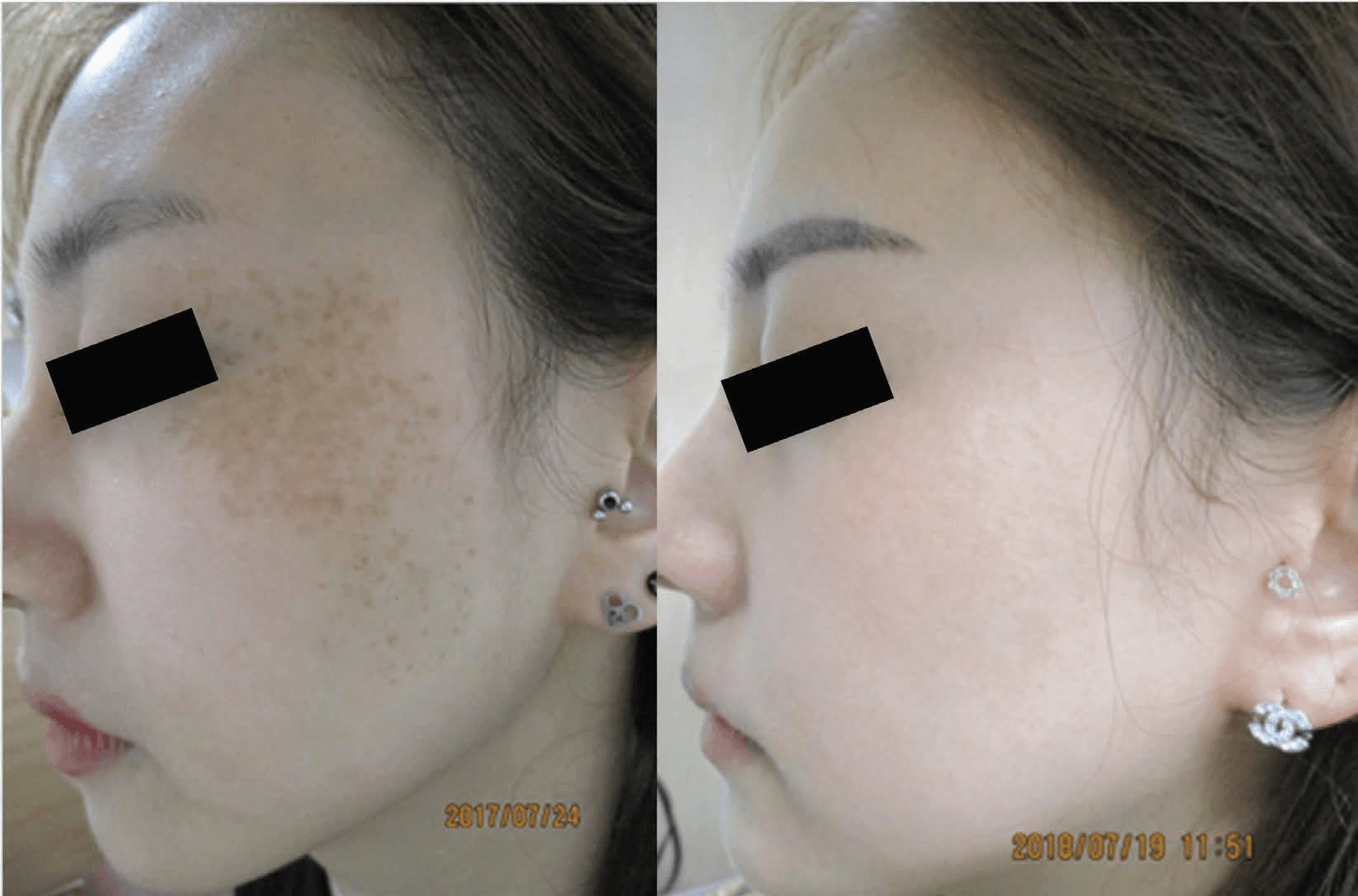 레이저치료 - (a) 좌측 안와주위부위, 좌측 관자놀이, 좌측 볼뼈부위, 좌측 뺨의 PUL(혼합형) (치료 전: 2017/7/24); (b) GPT 치료 후 