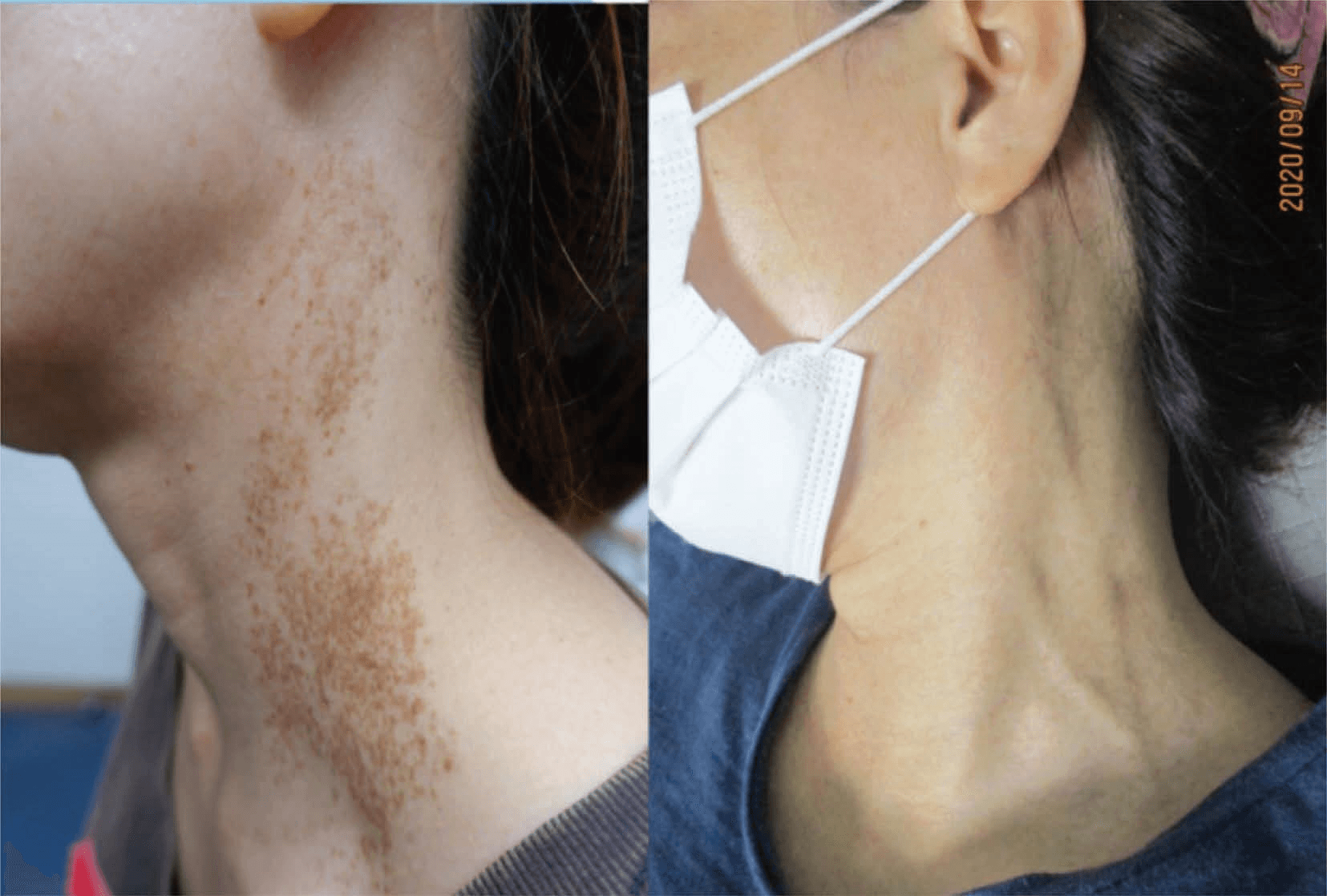 레이저치료 - (a) 좌측 하악부위와 좌측 측면 목의 PUL(혼합형) (치료 전: 2019/8/10); (b) GPT 치료 후 PUL의 완전한 소실 (치료 후