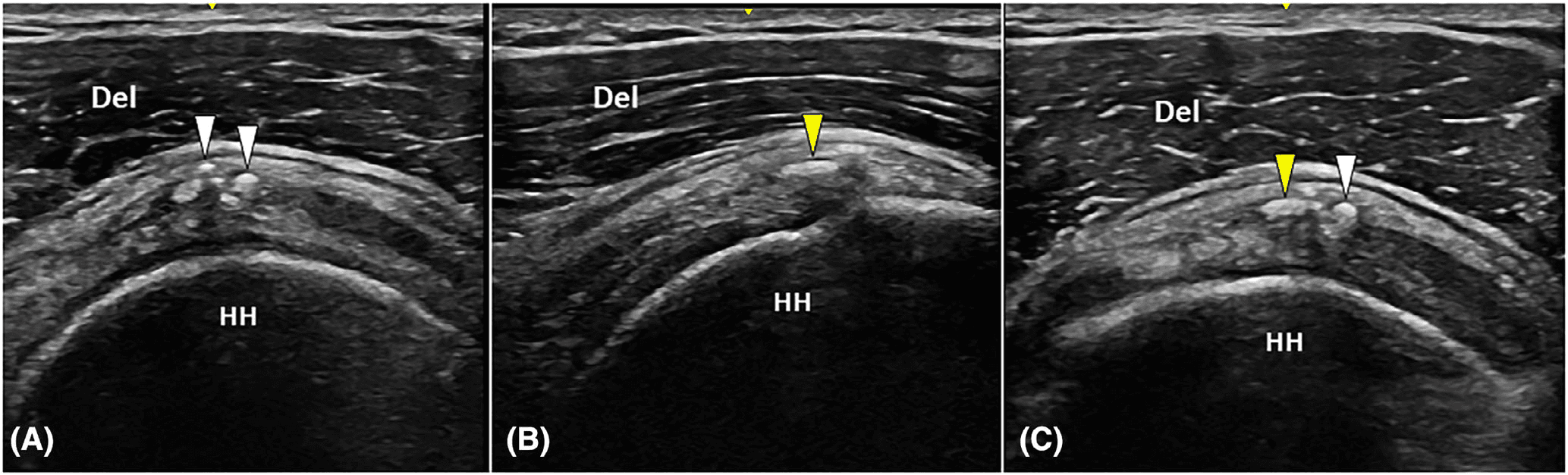 건초염 논문 Figure 2 — 임상 데이터 시각화