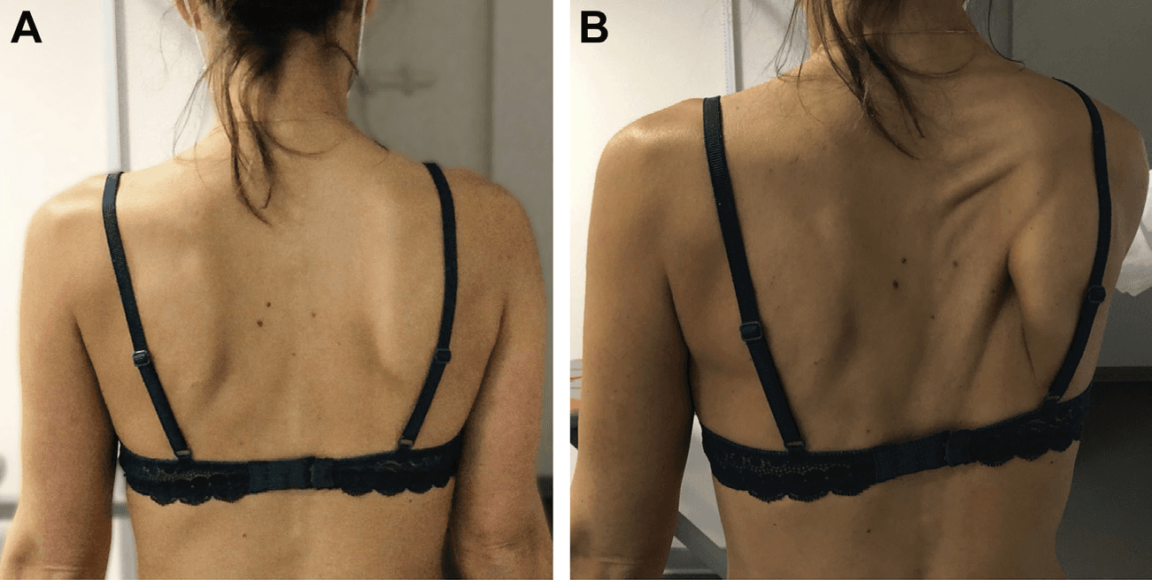 근전도검사 - 배측견갑신경병증으로 인한 견갑골 익상변형의 임상적 소견을 우측 어깨에서 보여주는 사진입니다. (A) 전형적인 우측 능형근(rhomboid mus