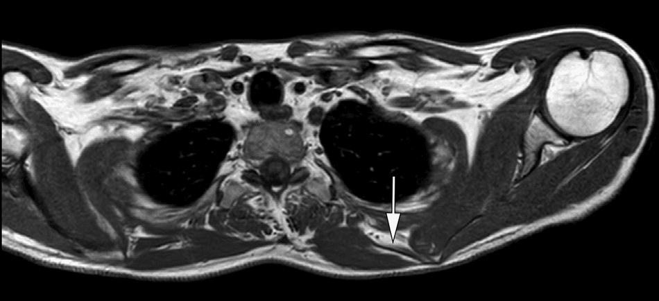 근전도검사 - 좌측 대능형근(major rhomboid muscle)의 위축을 보여주는 자기공명영상(MRI) T1 강조 축상면 영상입니다. 영상에서 좌측 대능