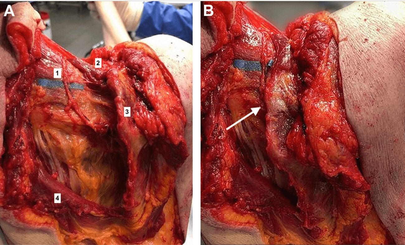 근전도검사 - 배측견갑신경의 동적 압박 기전을 설명하는 후방 해부학적 도식입니다. (A) 팔이 몸과 평행한 상태에서 능형근을 제거한 해부도로, 배측견갑신경(1