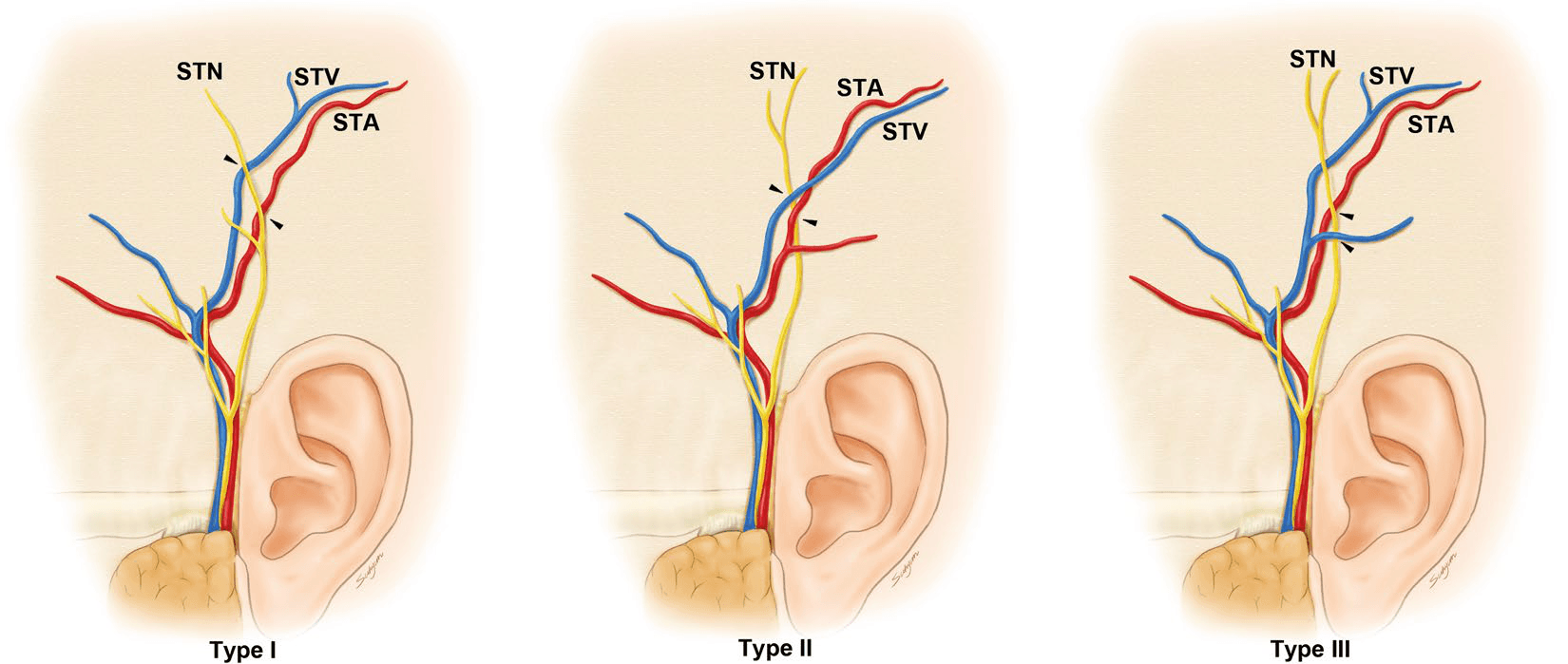측두동맥 - 이이신경(ATN), 측두천동맥(STA), 측두천정맥(STV) 간의 세 가지 교차 패턴을 형태학적 분류에 따라 도식화한 해부학적 모식도입니다. 화