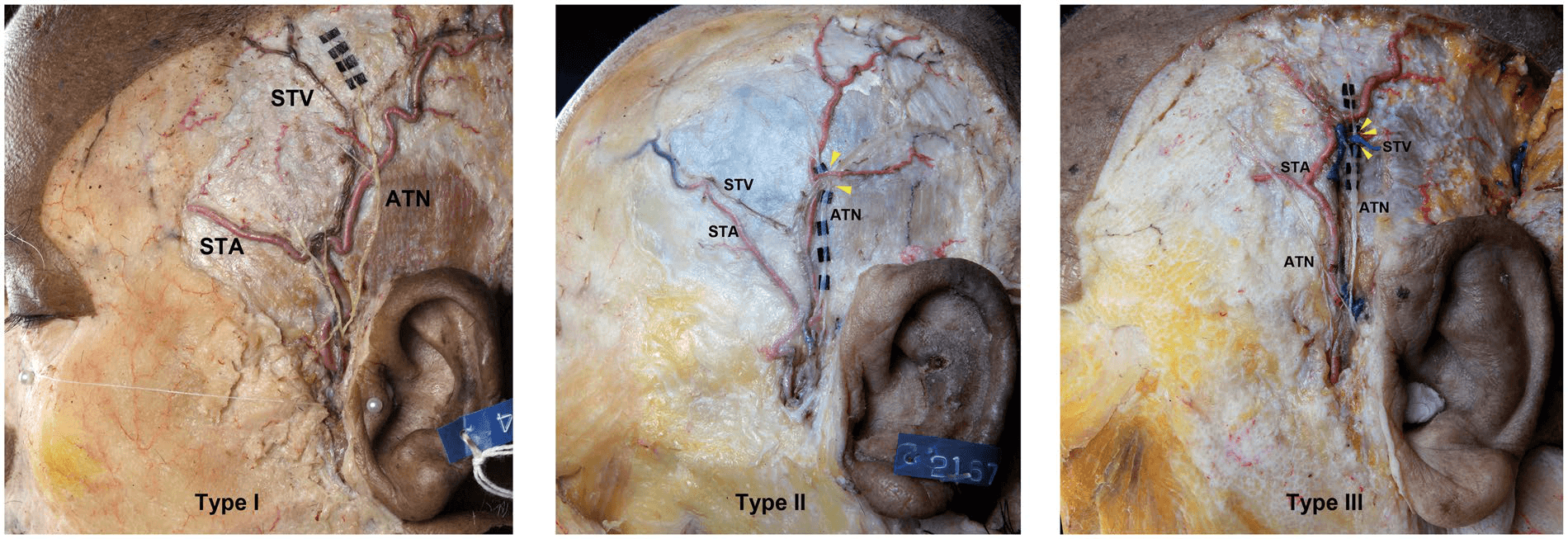 측두동맥 - 이이신경(ATN), 측두천동맥(STA), 측두천정맥(STV) 간의 위치 관계를 세 가지 유형으로 분류한 실제 해부 사진들입니다. (A) 제1형은