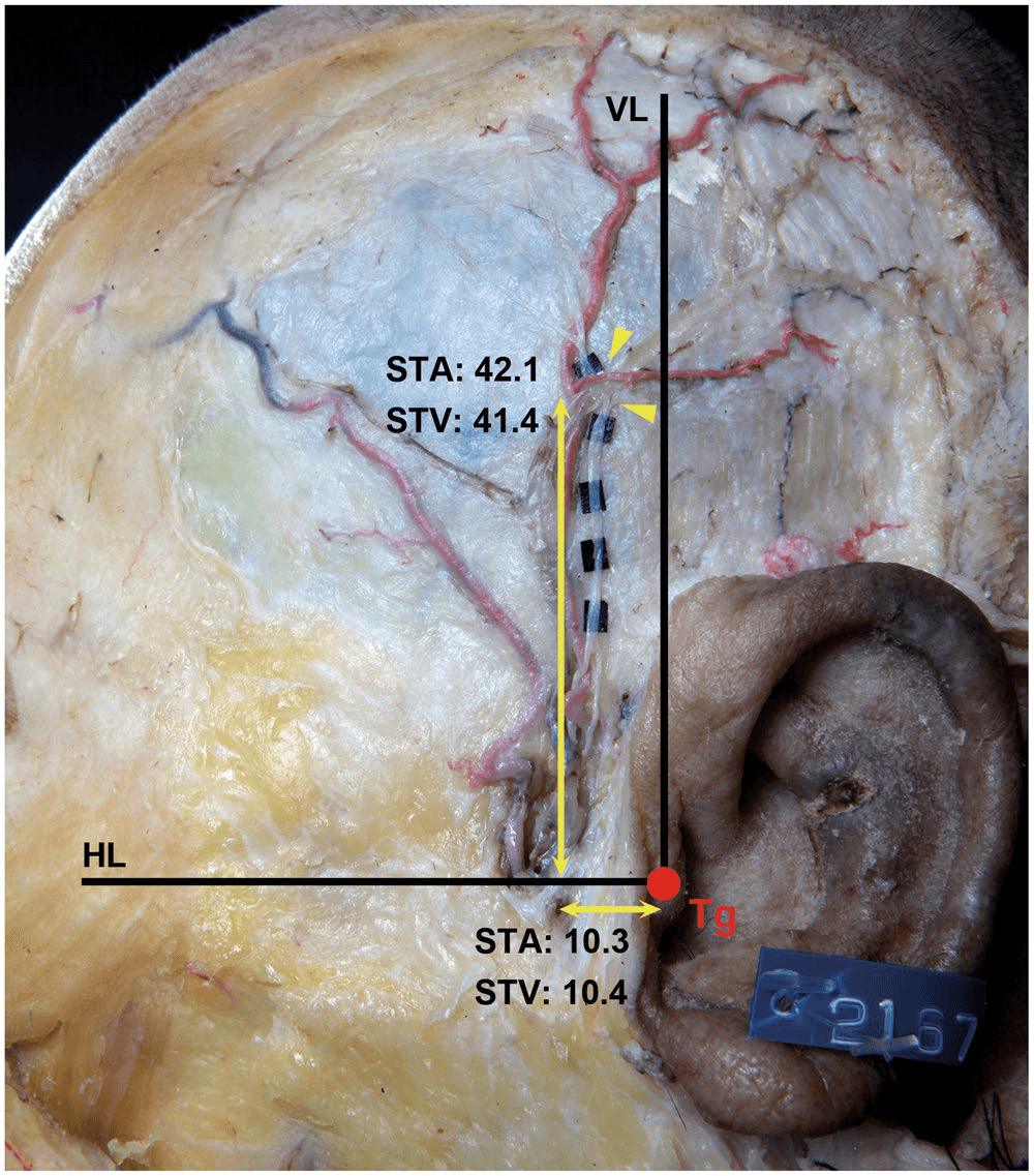 측두동맥 - 기준선을 바탕으로 이이신경(ATN), 측두천동맥(STA), 측두천정맥(STV) 간의 실제 교차점을 측정한 구체적 수치 예시 사진입니다. 이이신경