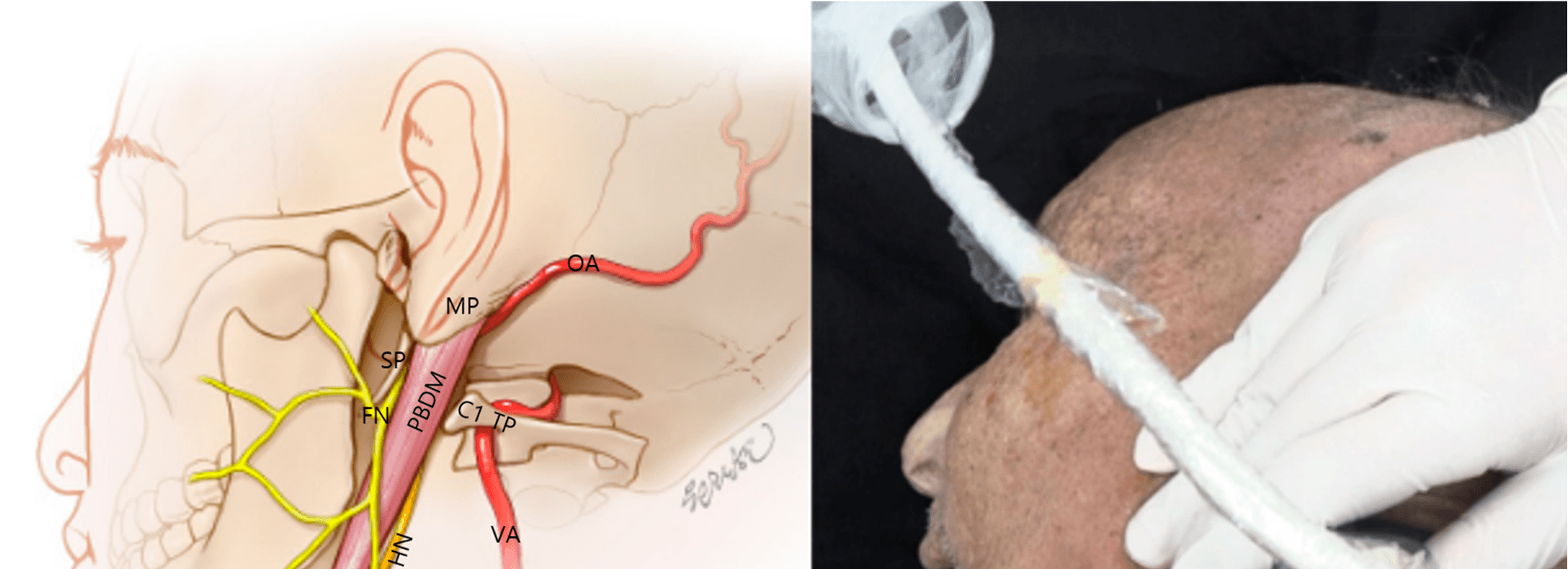 안면마비 - Anatomical   schematic   ( left )   and   cadaveric   ultrasound   probe   posit