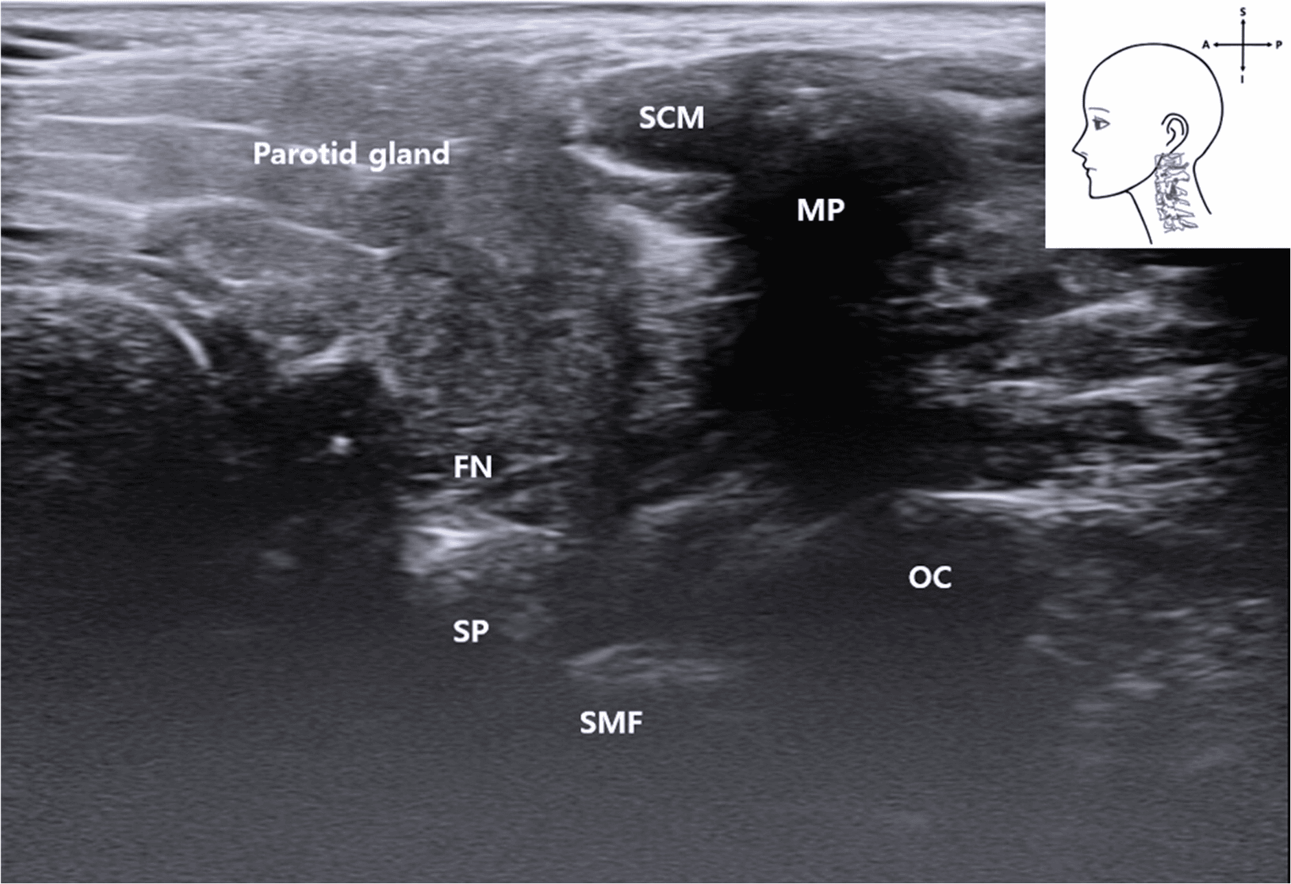 안면마비 - Ultrasound image showing the FN emerging between the mastoid and SP. The styloma