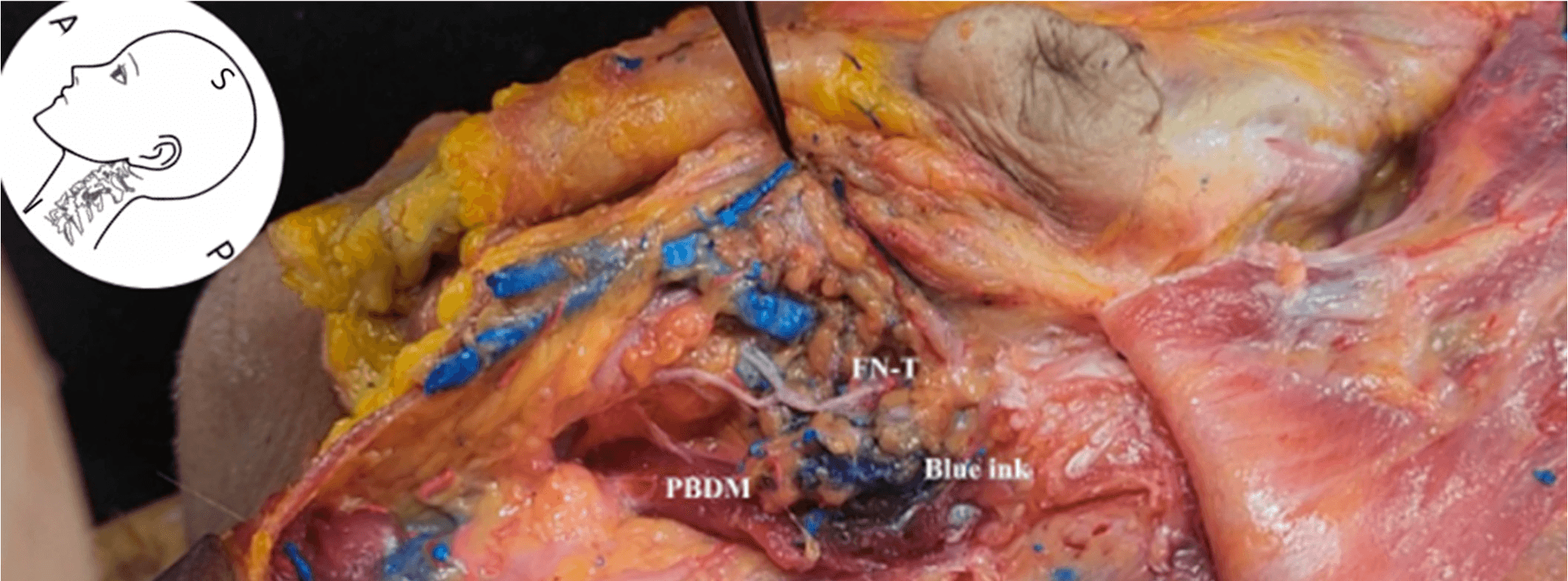 안면마비 - Cadaveric dissection showing the diffusion of blue dye following ultrasound-guid