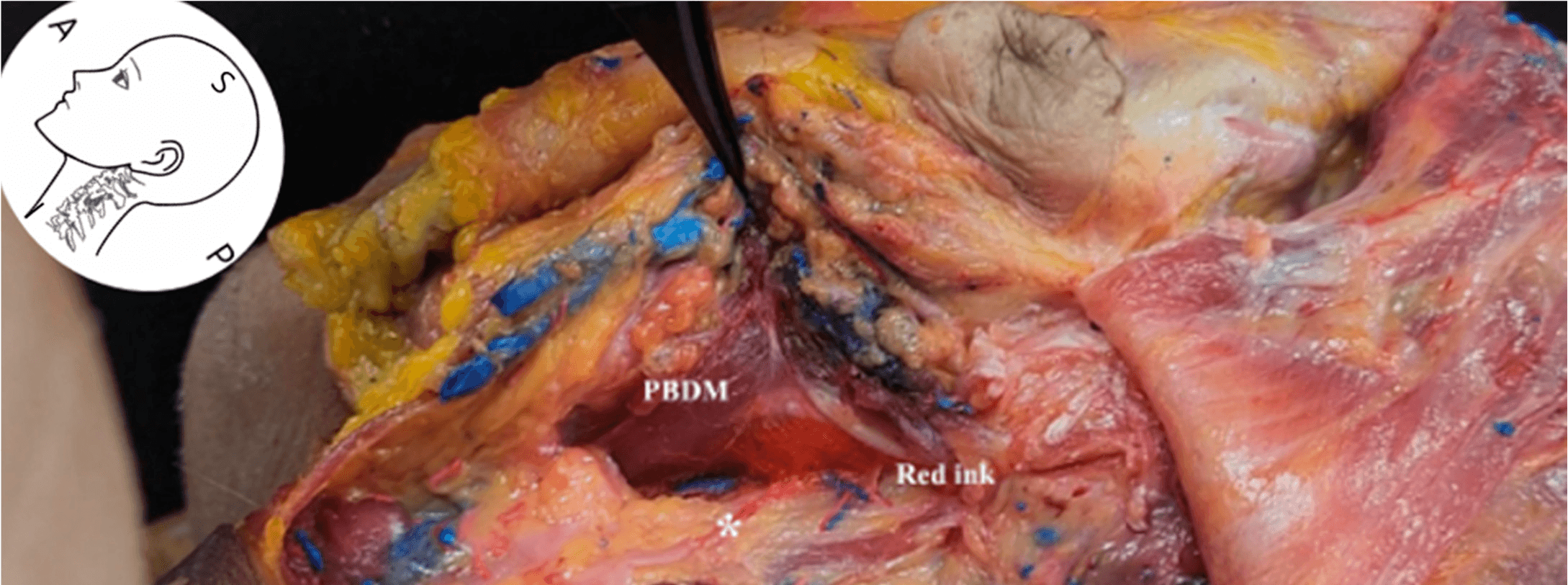 안면마비 - Cadaveric dissection showing red dye distribution following ultrasound-guided in