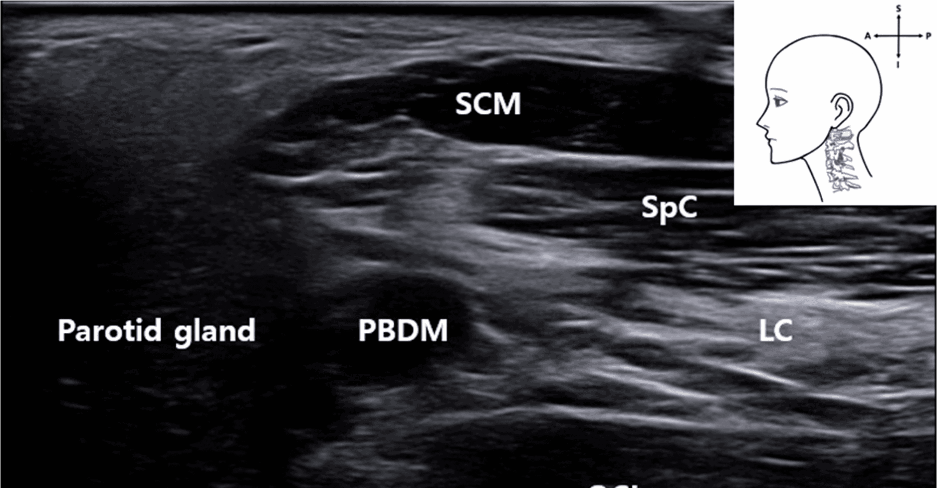 안면마비 - Ultrasound   image   corresponding   to   the   anatomical   dissection   of   t