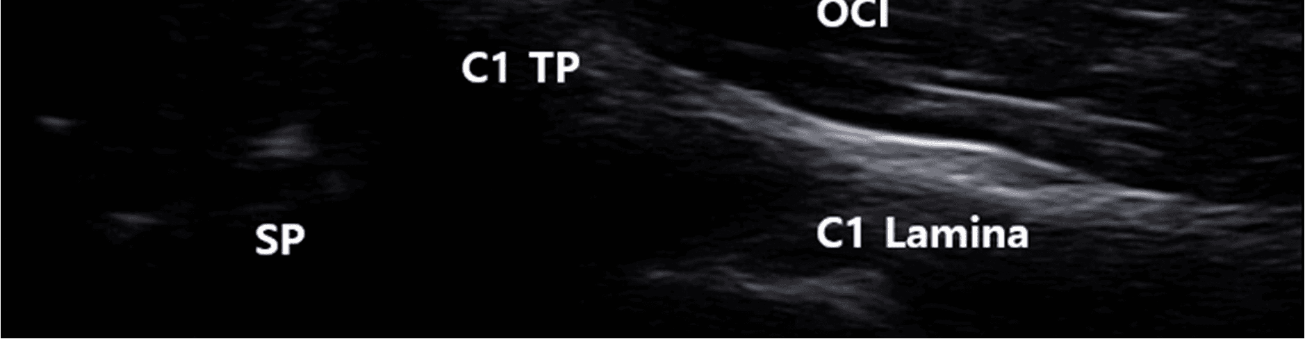 안면마비 - Ultrasound   image   corresponding   to   the   anatomical   dissection   of   t
