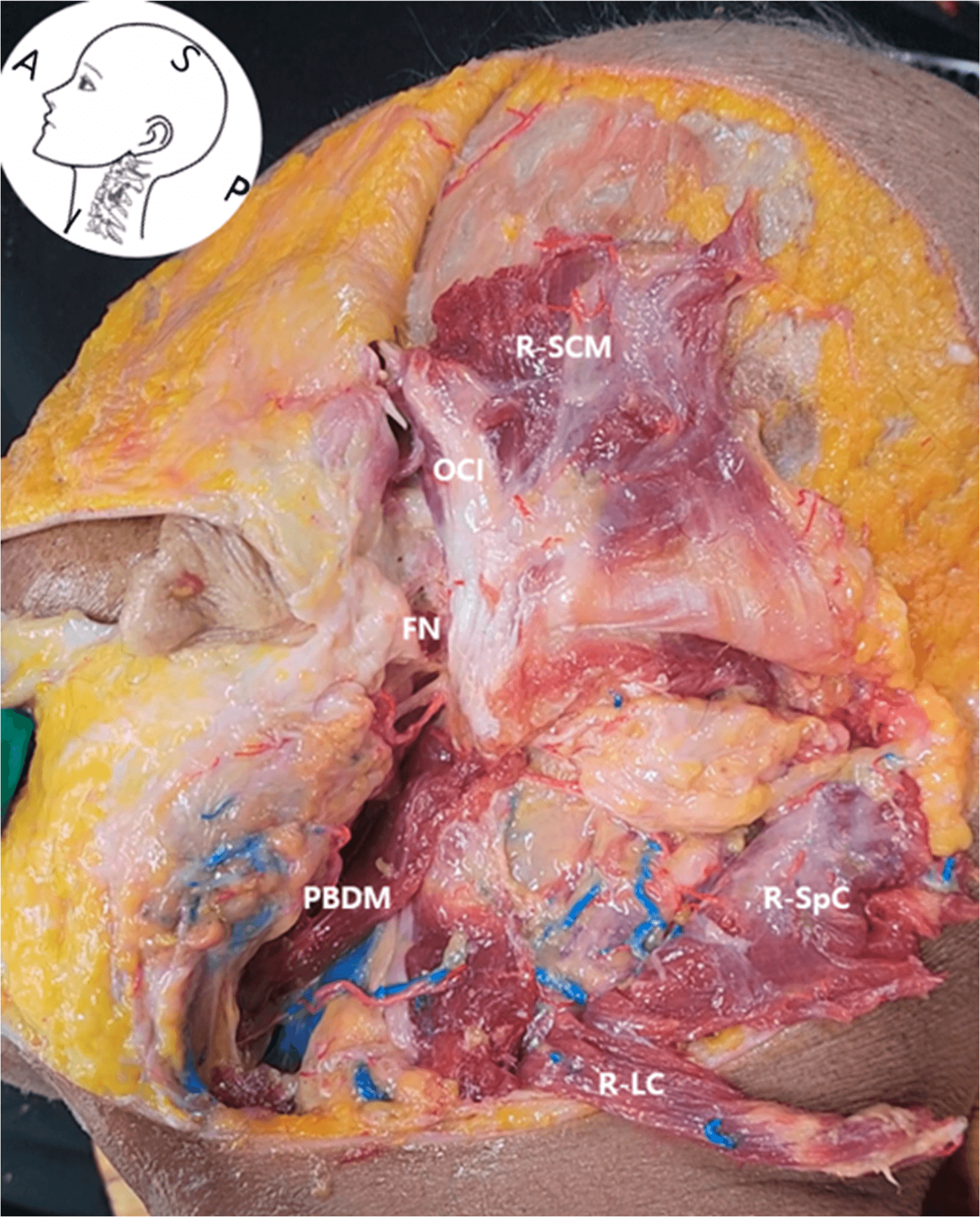 안면마비 - Layer-by-layer dissection of the right lateral neck showing key anatomical struc