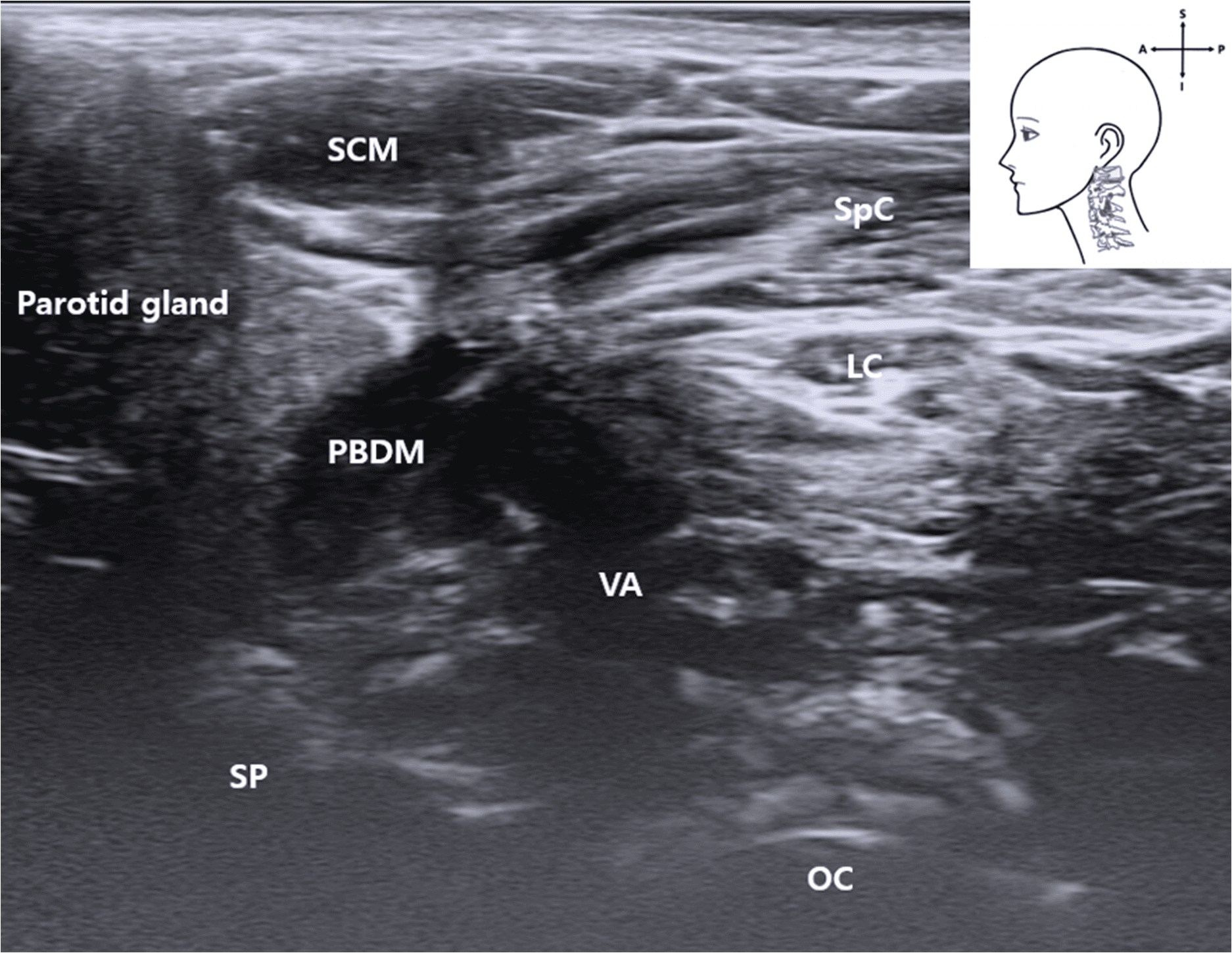안면마비 - Ultrasound image showing the VA located deep between the posterior belly of the 