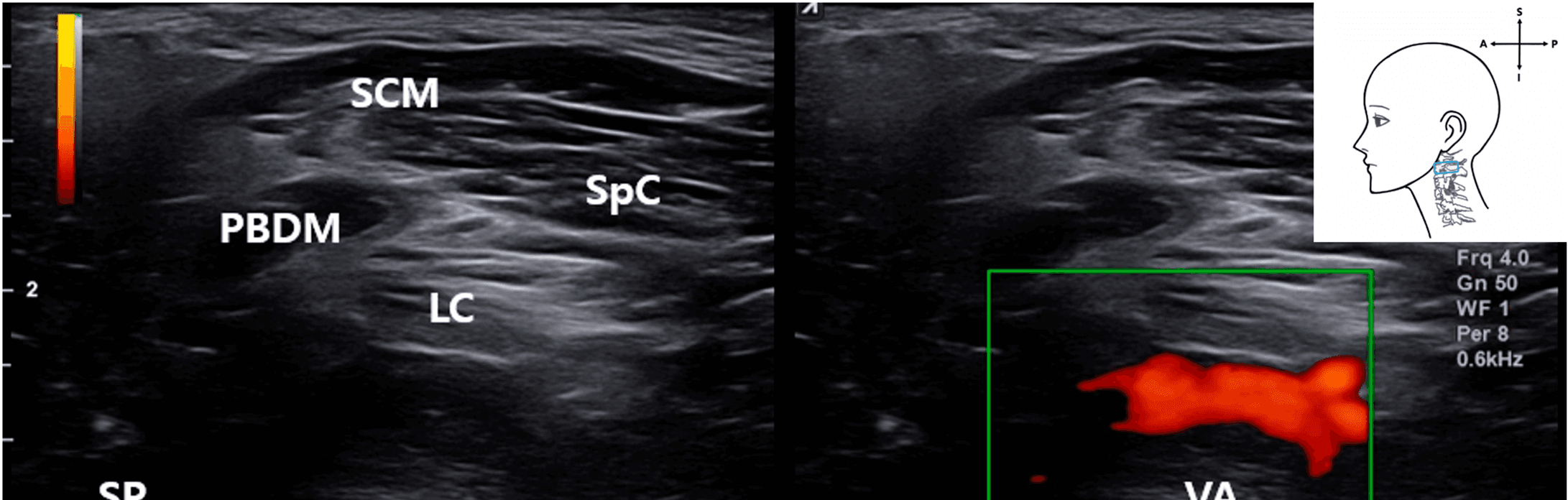 안면마비 - Live dual doppler ultrasound in a living patient confirming visualization of the