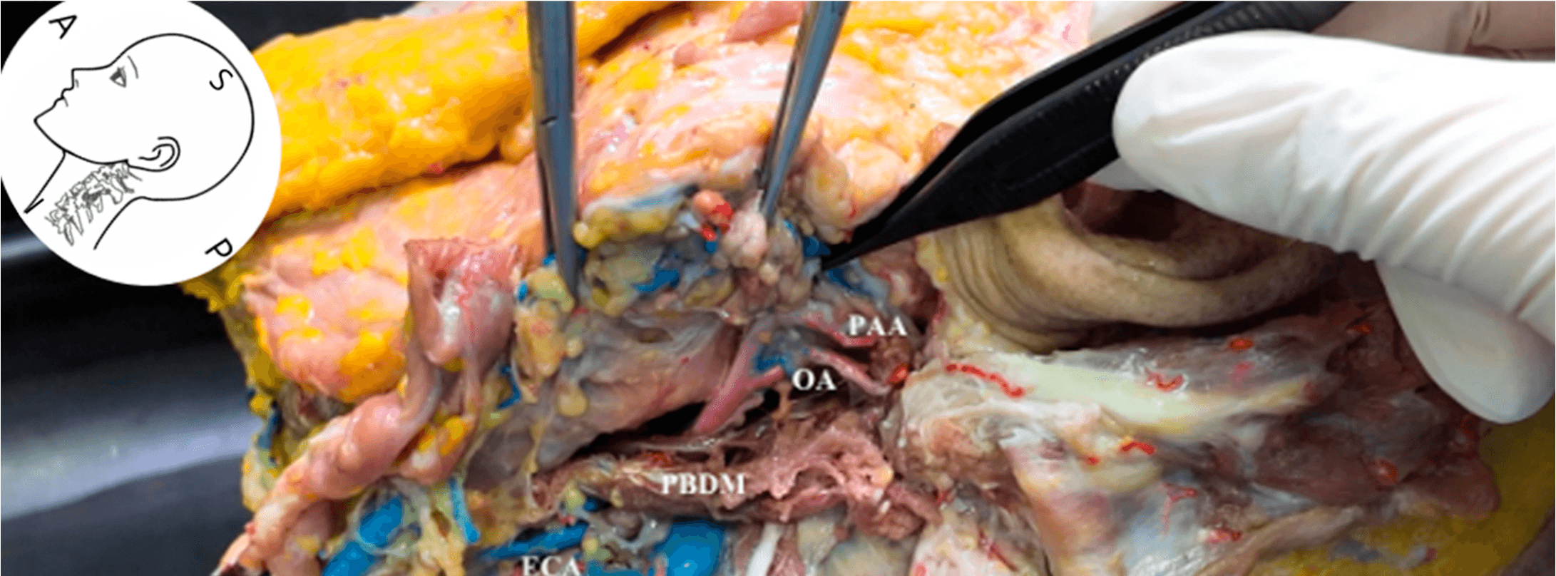 안면마비 - Cadaveric dissection showing the anatomical relationship of the OA. The OA arise