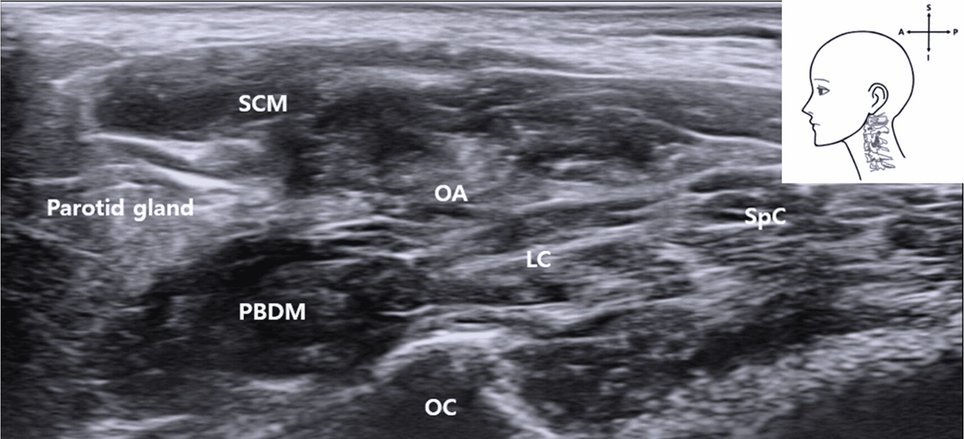 안면마비 - Ultrasound image showing the OA coursing parallel and just deep to the posterior