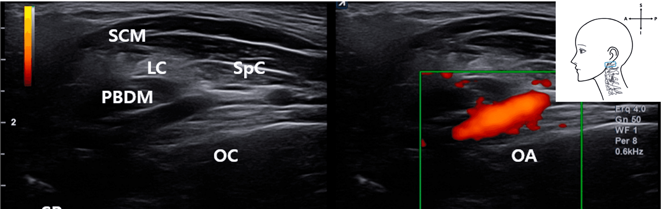 안면마비 - Color Doppler ultrasound image from a live patient showing the OA coursing obliq