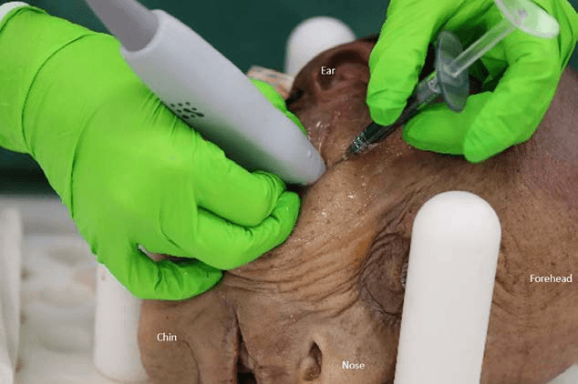 안면마비 - 경피적 초음파(US) 유도 하에 메틸렌 블루가 포함된 필러를 주입하는 과정을 보여주는 실험 영상입니다. 초음파 프로브를 피부 표면에 위치시켜 실