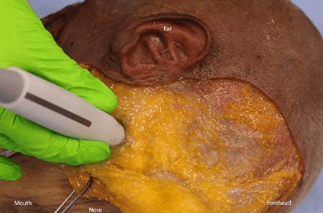 안면마비 - 피부 피판을 거상한 후 수술 중 초음파 시스템의 위치를 보여주는 술중 실험 장면입니다. 초음파 프로브가 표재성 근막지방층(SMAS, superf