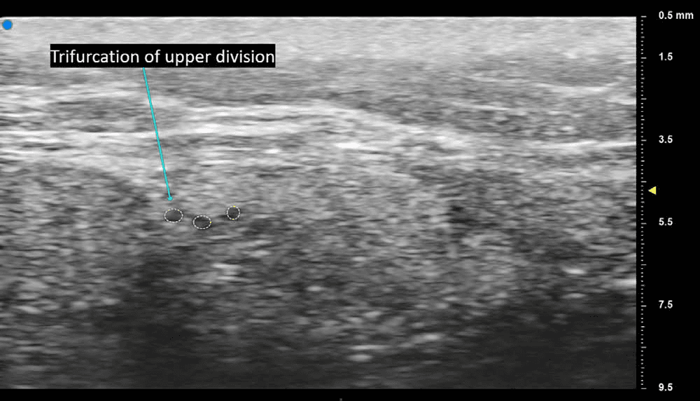 안면마비 - 안면신경 상분지의 삼분지 분기점을 축상면 초음파로 시각화한 영상입니다. 먼저 축상면 스캔으로 신경 구조를 확인한 후, 신경을 영상 중앙에 유지하