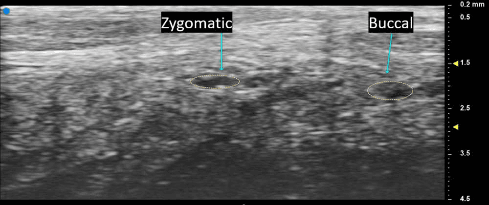 안면마비 - 안면신경의 관골지(zygomatic branch)와 협부지(buccal branch)를 축상면 초음파로 명확하게 구분하여 관찰한 영상입니다. 두