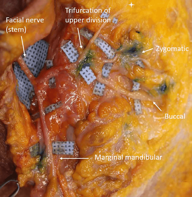 안면마비 - 해부 완료 후 가장 중요한 신경 분지들 바로 옆에 주입된 필러(인도시아닌 그린/메틸렌 블루)를 근접 촬영한 최종 확인 영상입니다. 우상단의 흰색