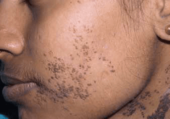 사마귀 - Figure 9 (a) - 왼쪽 볼과 목 부위에 발생한 사마귀양 표피모반의 임상 양상을 나타낸 사진입니다. (a) 치료 전 병변의 모습으로 사마귀 같은 