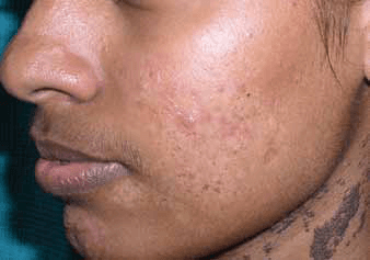 사마귀 - Figure 9 (b) - 왼쪽 볼과 목 부위에 발생한 사마귀양 표피모반의 임상 양상을 나타낸 사진입니다. (a) 치료 전 병변의 모습으로 사마귀 같은 