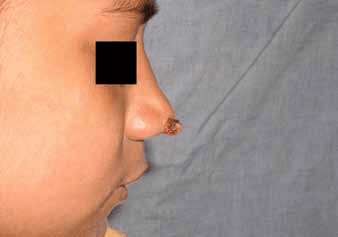 사마귀 - Figure 11 (a) - 육아종성 혈관종의 치료 전 임상 모습을 보여주는 사진입니다. (a)와 (b)는 각각 다른 각도에서 촬영된 병변으로, 전형적인 