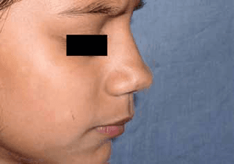 사마귀 - Figure 11 (b) - 육아종성 혈관종의 치료 전 임상 모습을 보여주는 사진입니다. (a)와 (b)는 각각 다른 각도에서 촬영된 병변으로, 전형적인 