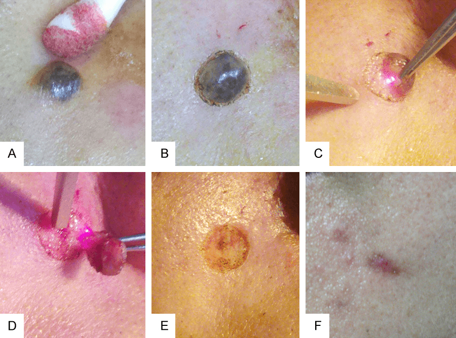 색소침착 - Figure 2 - 45세 여성 환자의 좌측 구각 하방에 위치한 직경 7mm 모반의 펄스 레이저를 이용한 단계별 절제 과정을 보여주는 임상 사진입