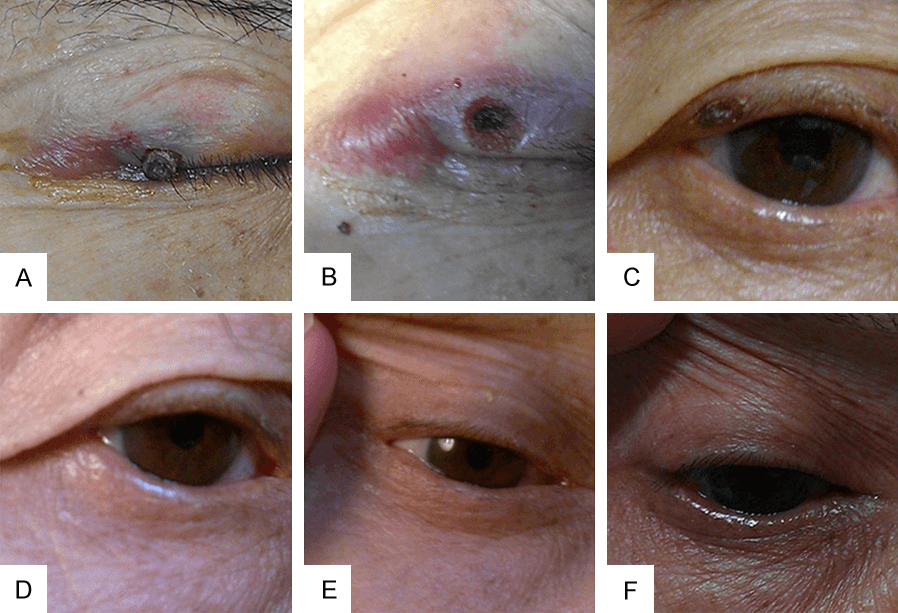 색소침착 - Figure 3 - 61세 남성 환자의 우측 상안검에 위치한 5mm 크기 모반의 레이저 치료 과정과 장기 추적 결과를 보여주는 임상 사진입니다. 