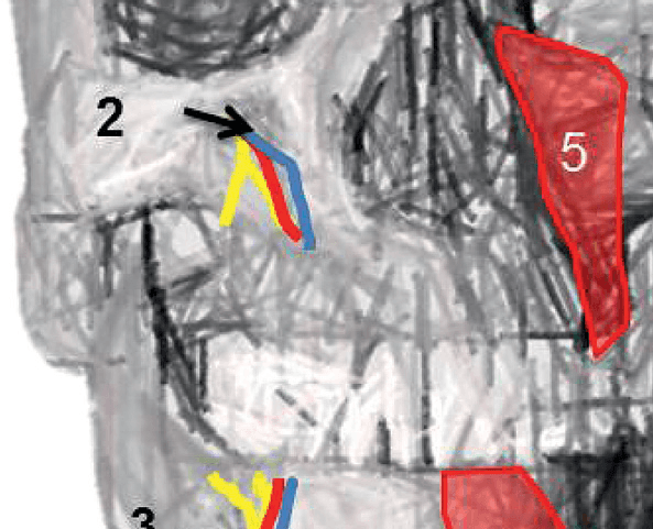 상완신경총 - Figure 1 - 전방사각근 제거 후 상완신경총의 전반적인 해부학적 구조를 사체모델과 도식으로 보여주는 영상입니다. (A) 사체모델에서 전방사각