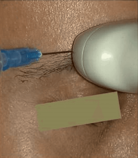 상완신경총 - Figure 3 - 원문 캡션입니다 (자동 번역 실패 — 원문 표기): Figure 3.  The C7 transverse process usua