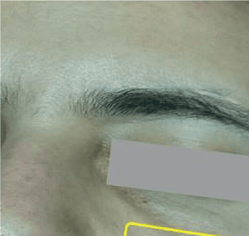 상완신경총 - Figure 4 - 원문 캡션입니다 (자동 번역 실패 — 원문 표기): Figure 4.  Schematic drawing ( A ), X-ray