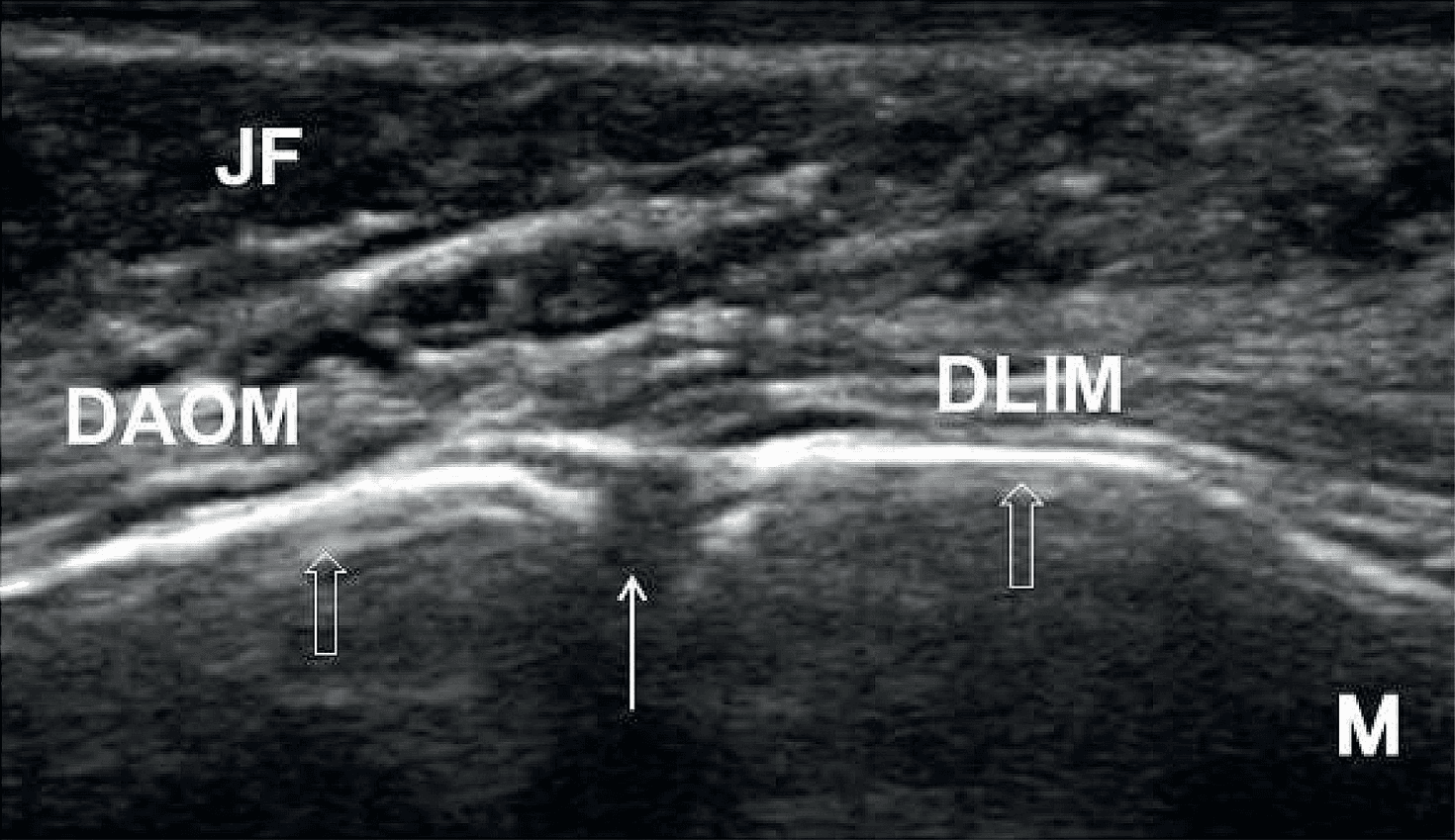 상완신경총 - Figure 5 - 원문 캡션입니다 (자동 번역 실패 — 원문 표기): Figure 5.  Ultrasound imaging of the C8 a