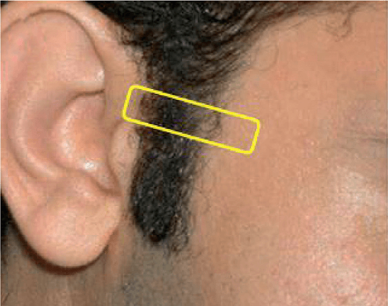 상완신경총 - Figure 6 - 원문 캡션입니다 (자동 번역 실패 — 원문 표기): Figure 6.  The transverse cervical artery